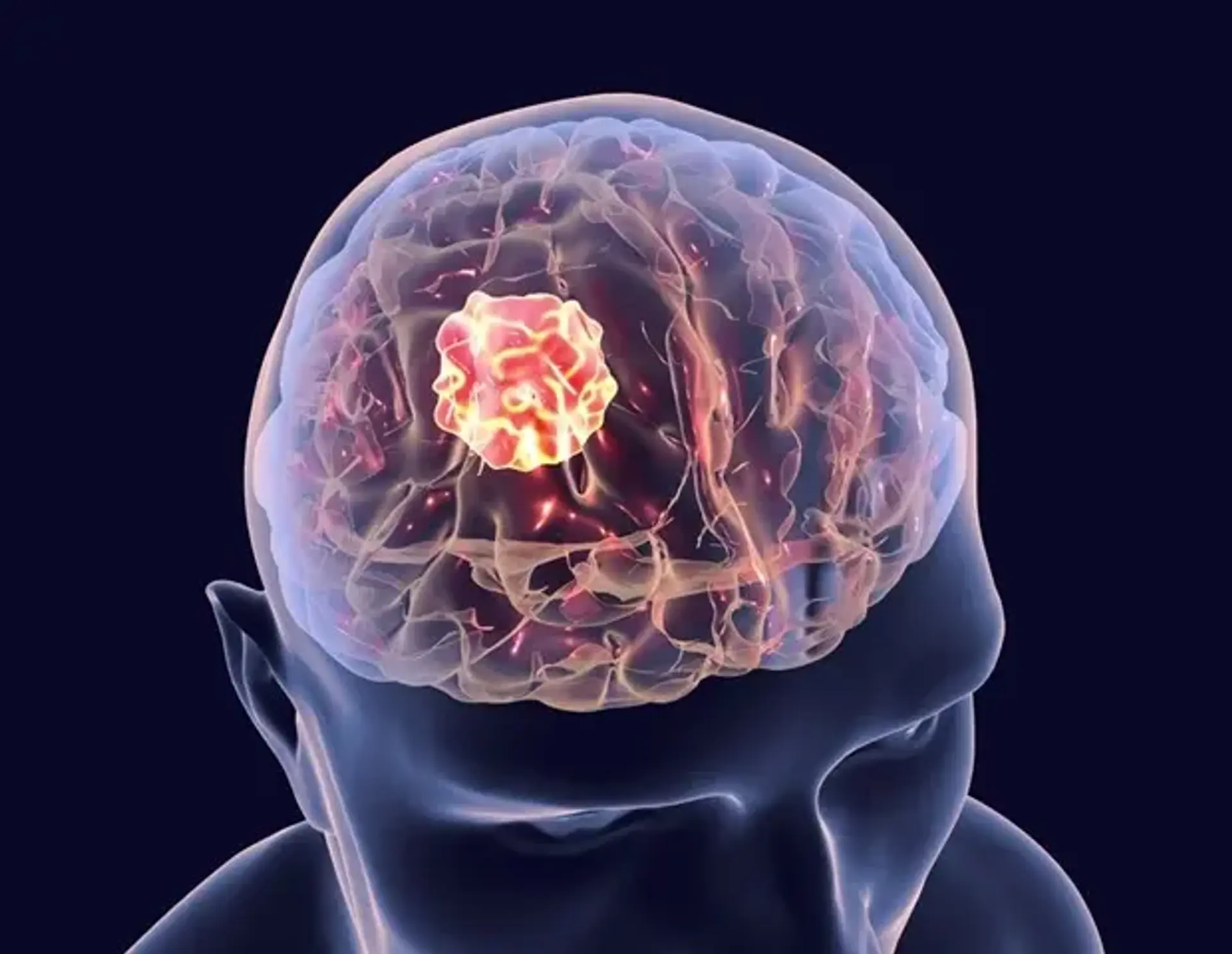 AI improves brain cancer detection