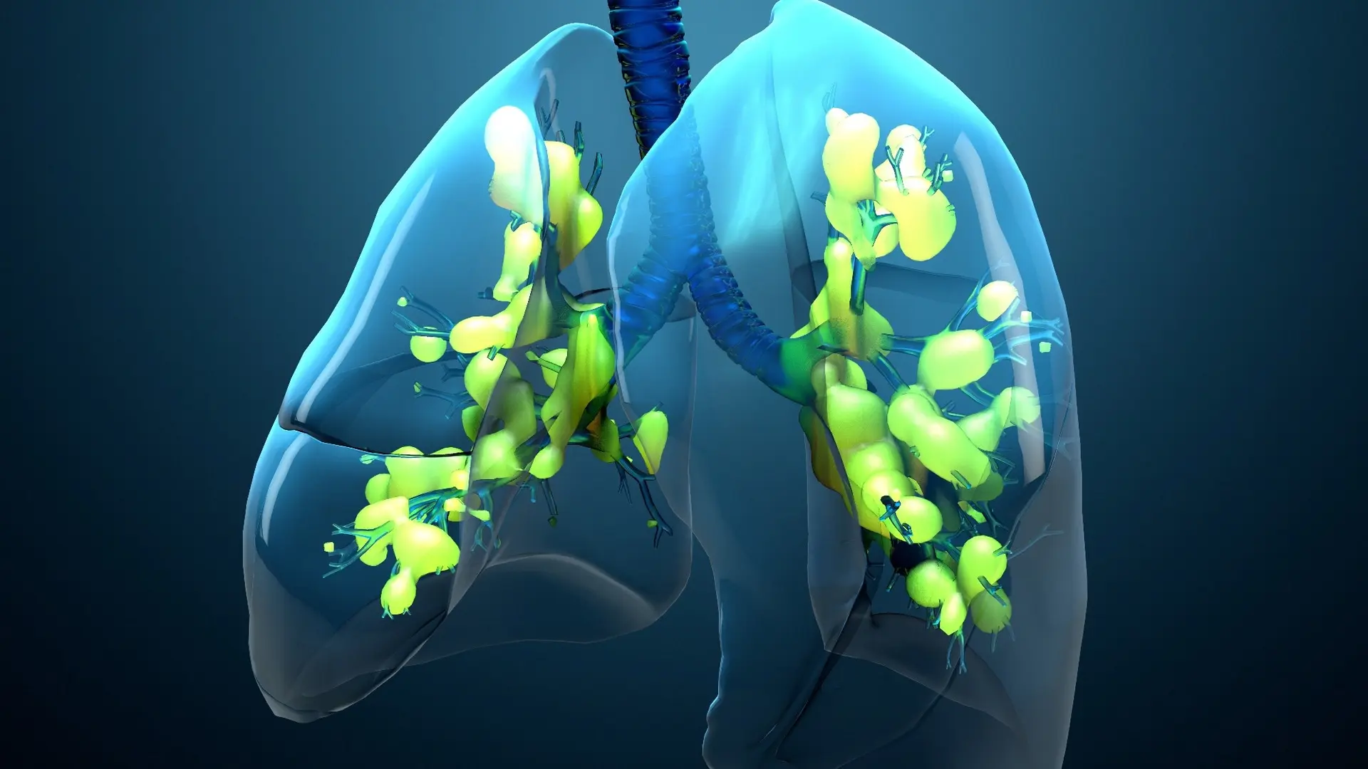 AI Revolutionises ARDS Treatment