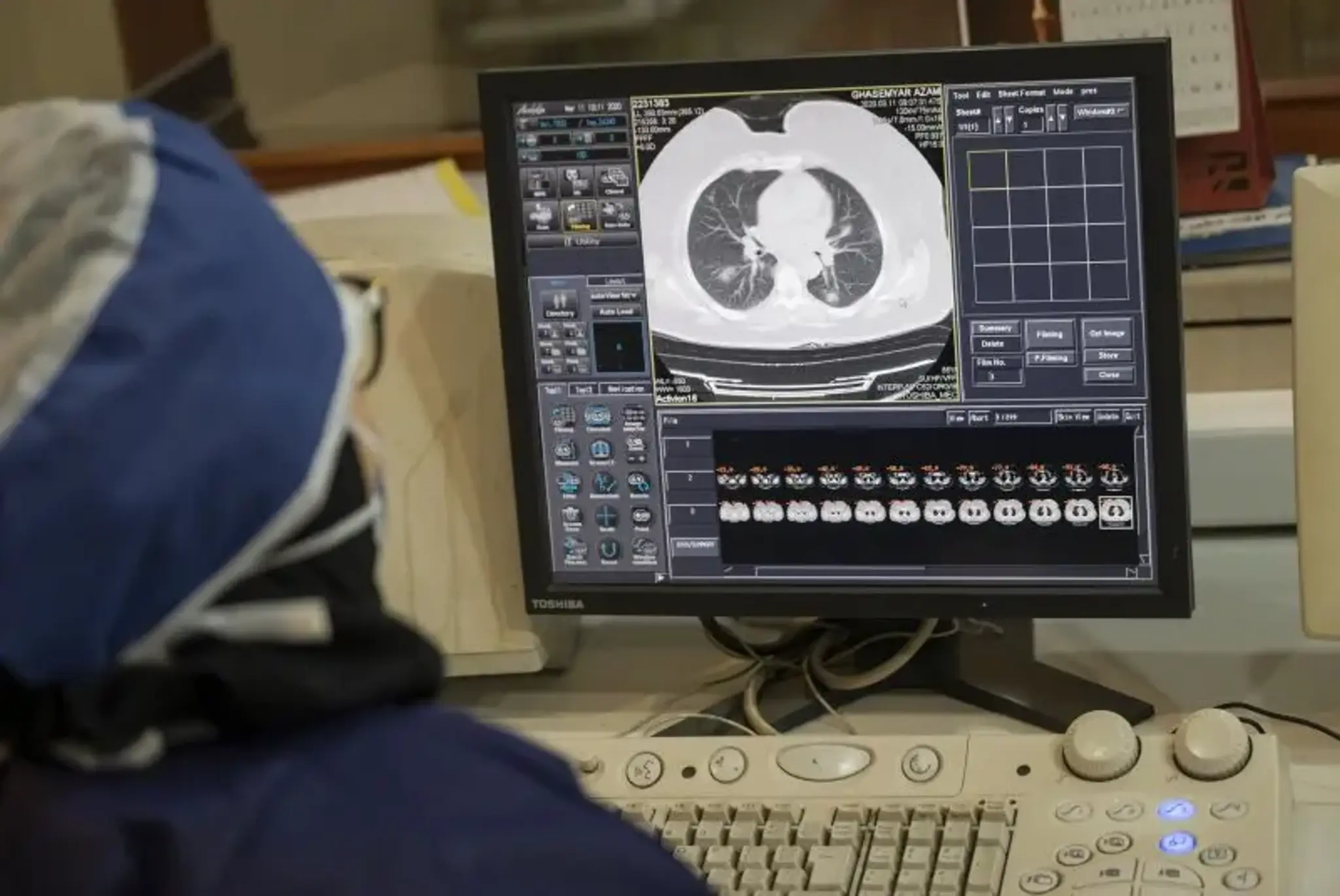 AI predicts lung cancer