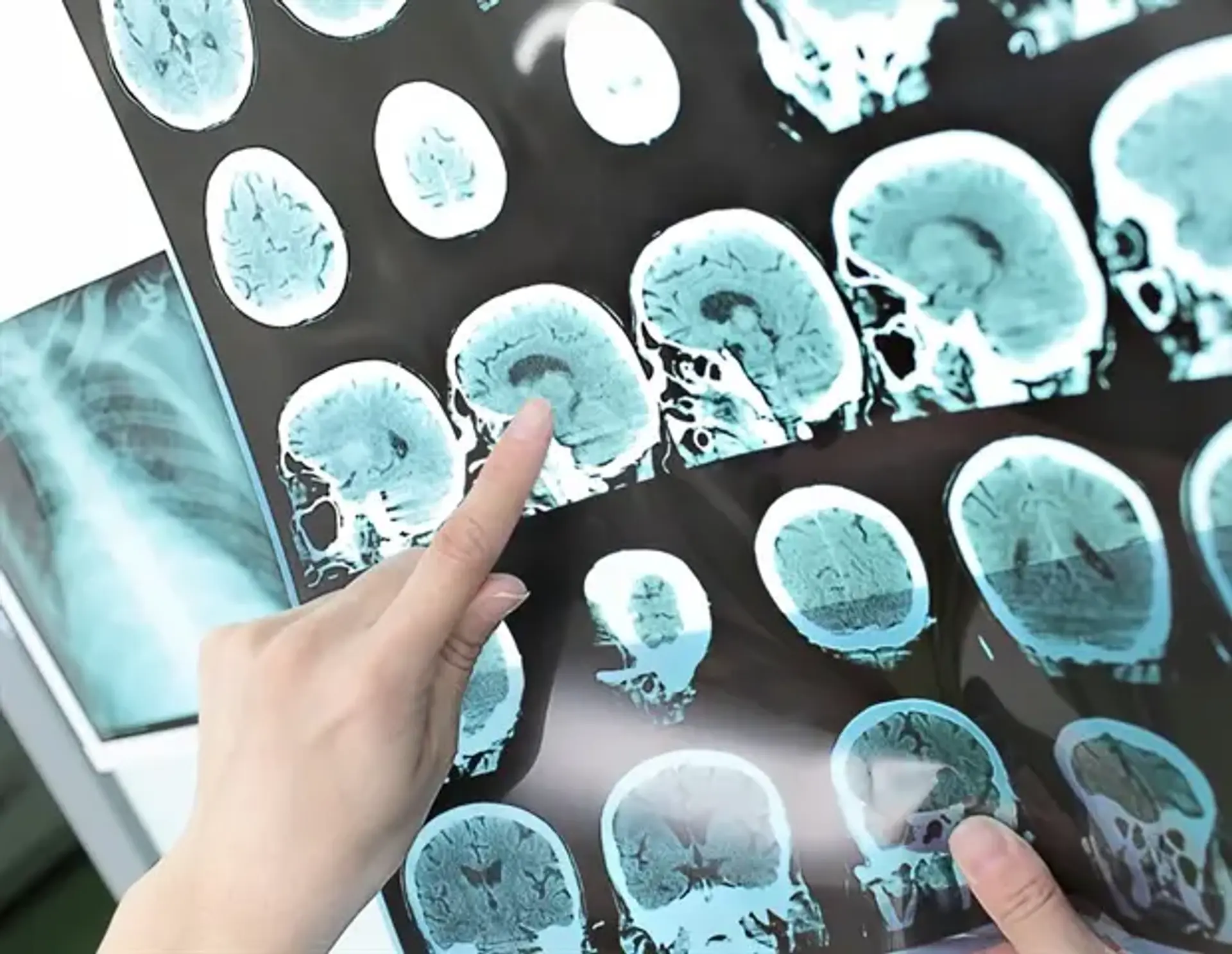 AI Stroke Treatment Model