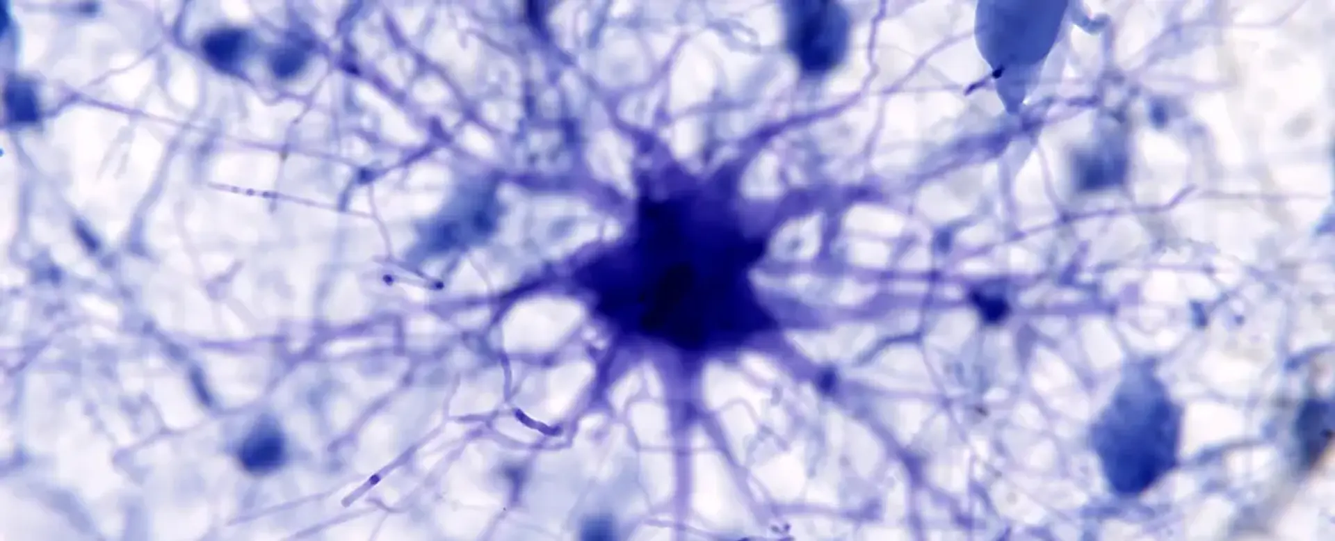 AI targets Alzheimer's trigger